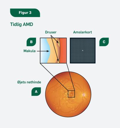 Billedet viser øjets nethinde, hvor Den gule plet er blevet forstørret, der viser tidlig stadie af hvordan druser ser ud.