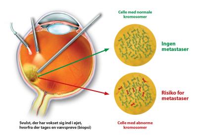 Svulst, der har vokset sig ind i øjet, hvorfra der tages en vævsprøve (biopsi).