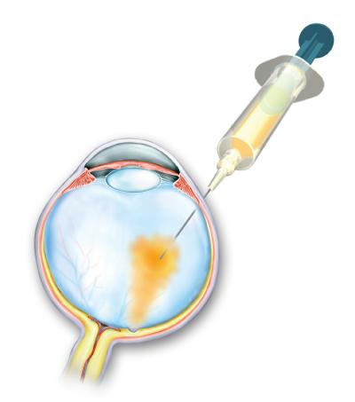 Injektion af antistof i øjets glaslegeme. 