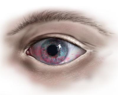 Det røde farvestof samler sig ved defekter i øjets slimlag