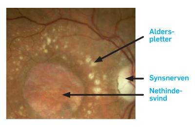Øjenbaggrund hos en patient med fremskreden tør AMD