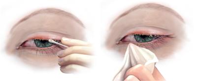 Rengøring af øjenlåg. Gel påsmøres og fjernes efterfølgende med vatpind.