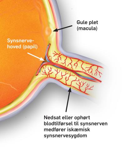 Sygdom i synsnerven