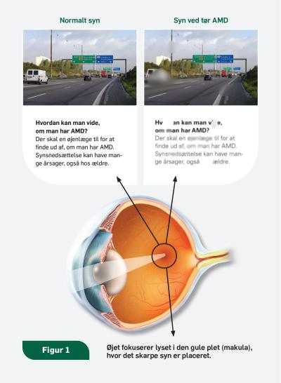 Billedet viser et rask øje og to billeder af en motorvej  som viser forskellen på et normalt syn og et AMD syn.