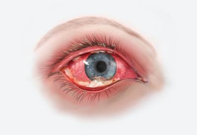 praktiserende læge Undvigende Grund Rødt øje | Øjenforeningen