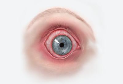 Nægte Pludselig nedstigning Takt Rødt øje | Øjenforeningen