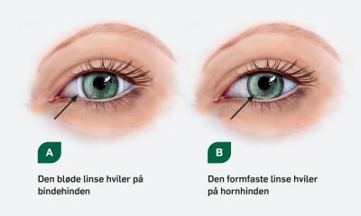 forholdet Dovenskab Urskive Kontaktlinser | Øjenforeningen