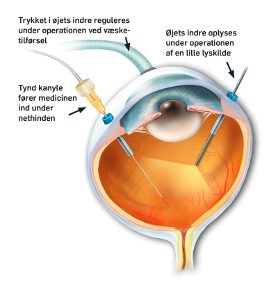 Tværsnit af et øje med en lille nål, og en anden nål med en lyskilde i.