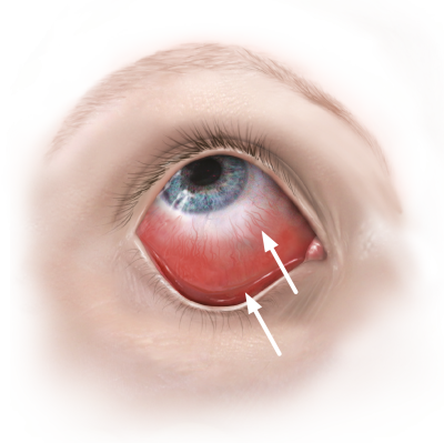 Øjenbetændelse - et udbredt øjenproblem hos børn voksene | Øjenforeningen