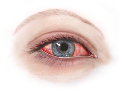 Billede af et øje med meget synlige blodåre
