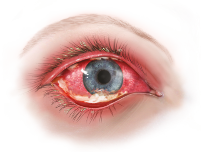 Billede af et røde, hvor det hvide er helt rødt, og der synligt pus nederst i øjet