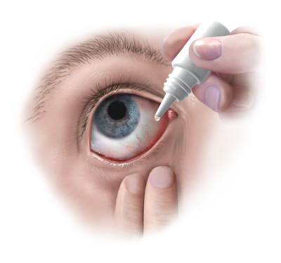 Minde om kapsel Tårer Øjenbetændelse - et udbredt øjenproblem hos børn og voksene | Øjenforeningen