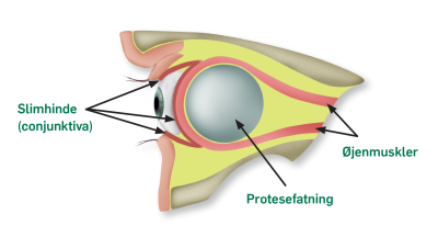 Placering af akrylprotese og protesefatning mellem slimhinde og øjenmuskler set fra siden 
