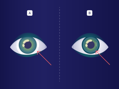 Øjen illustration af kontaktlinser