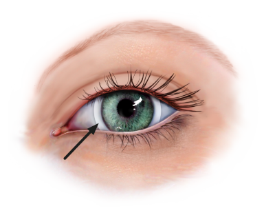 kontaktlinser eller øjenoperation hvad skal jeg | Øjenforeningen
