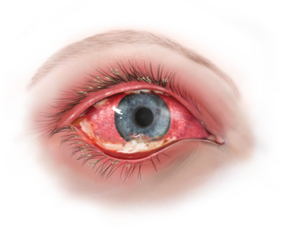 Rødt øje - med øjenbetændelse - gult puds
