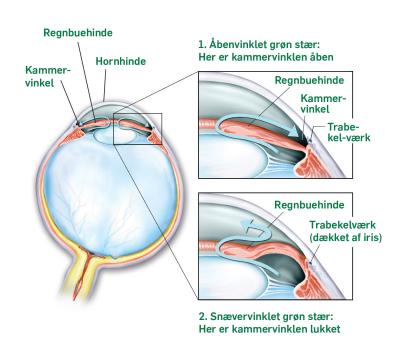 Grøn stær (Glaukom) Øjenforeningen