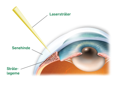 Billede af en laserbehandling af øjet