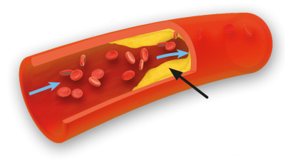 Kolesterolaflejring danner sår på indersiden af blodåre.