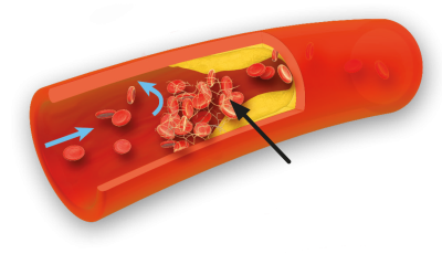 Blodlegemer samler sig og klæber sammen via fibrin markeret som hvide tråddannelser.
