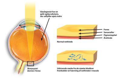 begynde via næse Ny behandling af blodprop i nethinden | Øjenforeningen