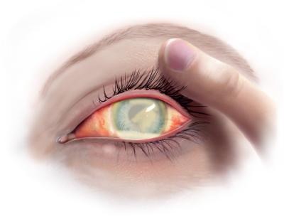 Nethindeløsning og infektion øjet | Øjenforeningen